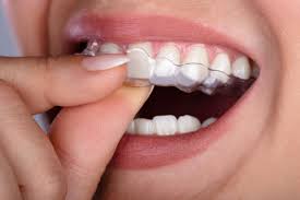 Dental Aligners Slide 2